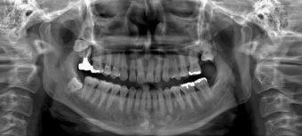 Ray RAYSCAN Alpha P – ортопантомограф