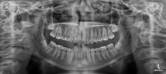 Томограф HDX Will Dentri 3D Classic 16x8